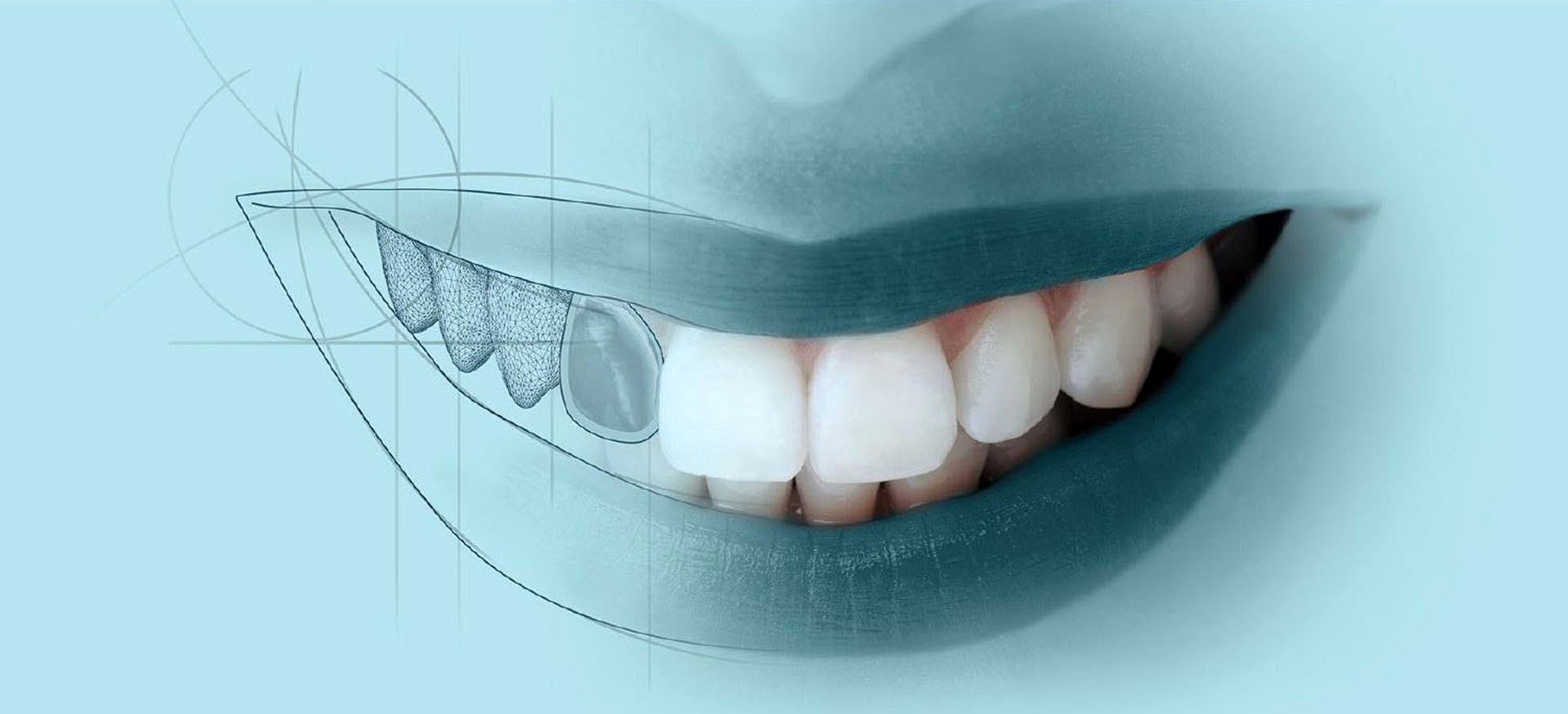 Diseño prótesis dentales mediante tecnología Cad-Cam