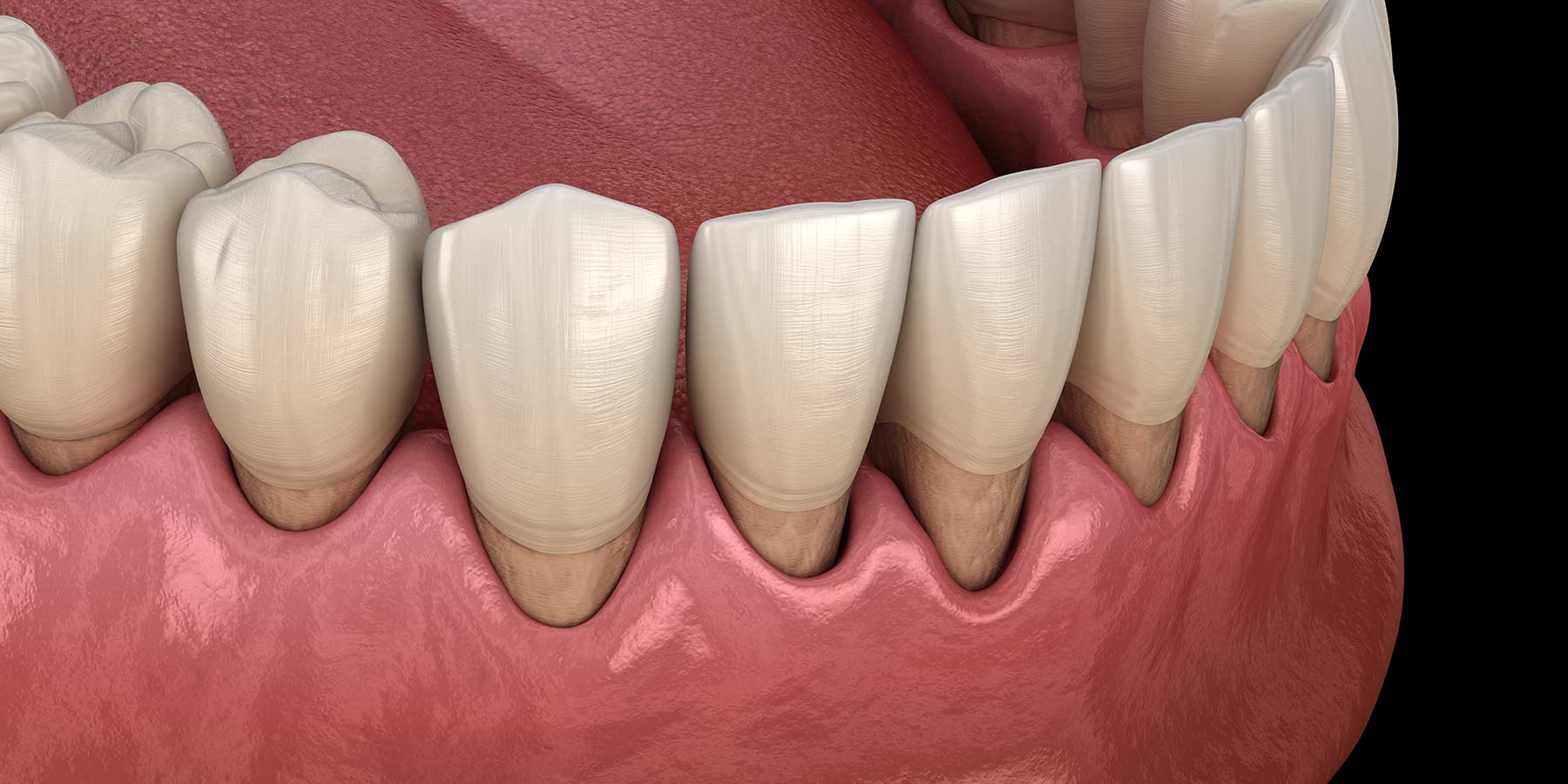 Periodontitis avanzada: causas, síntomas y cómo tratarla antes de perder los dientes
