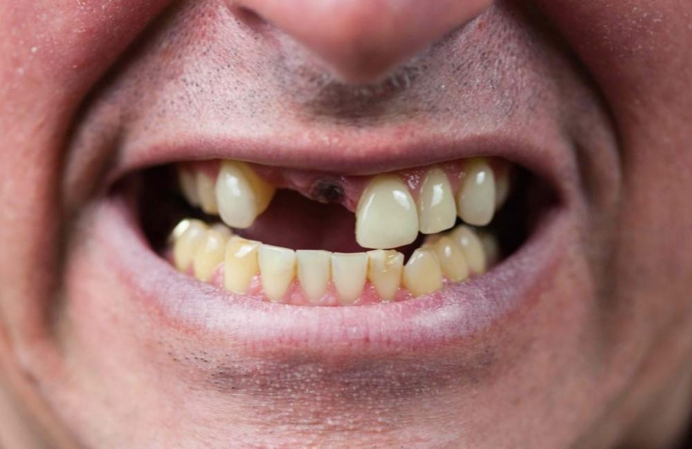 Ausencias dentales: qué sucede cuando faltan dientes y cómo solucionarlo