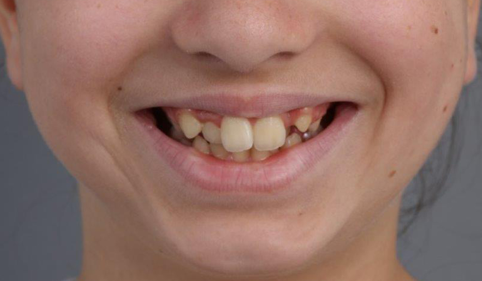 Disyuntor dental: qué es, para qué sirve y guía completa actualizada