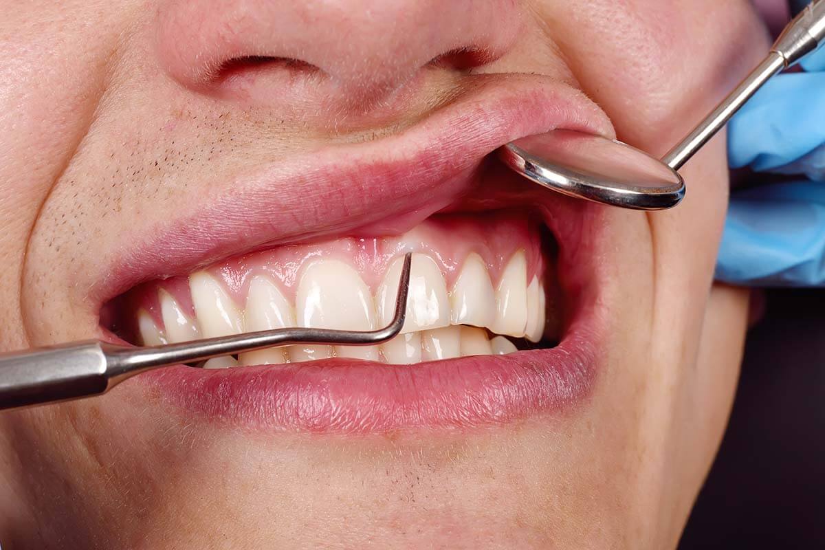¿Cómo es el tratamiento periodontal? ¿Cura la piorrea para siempre?