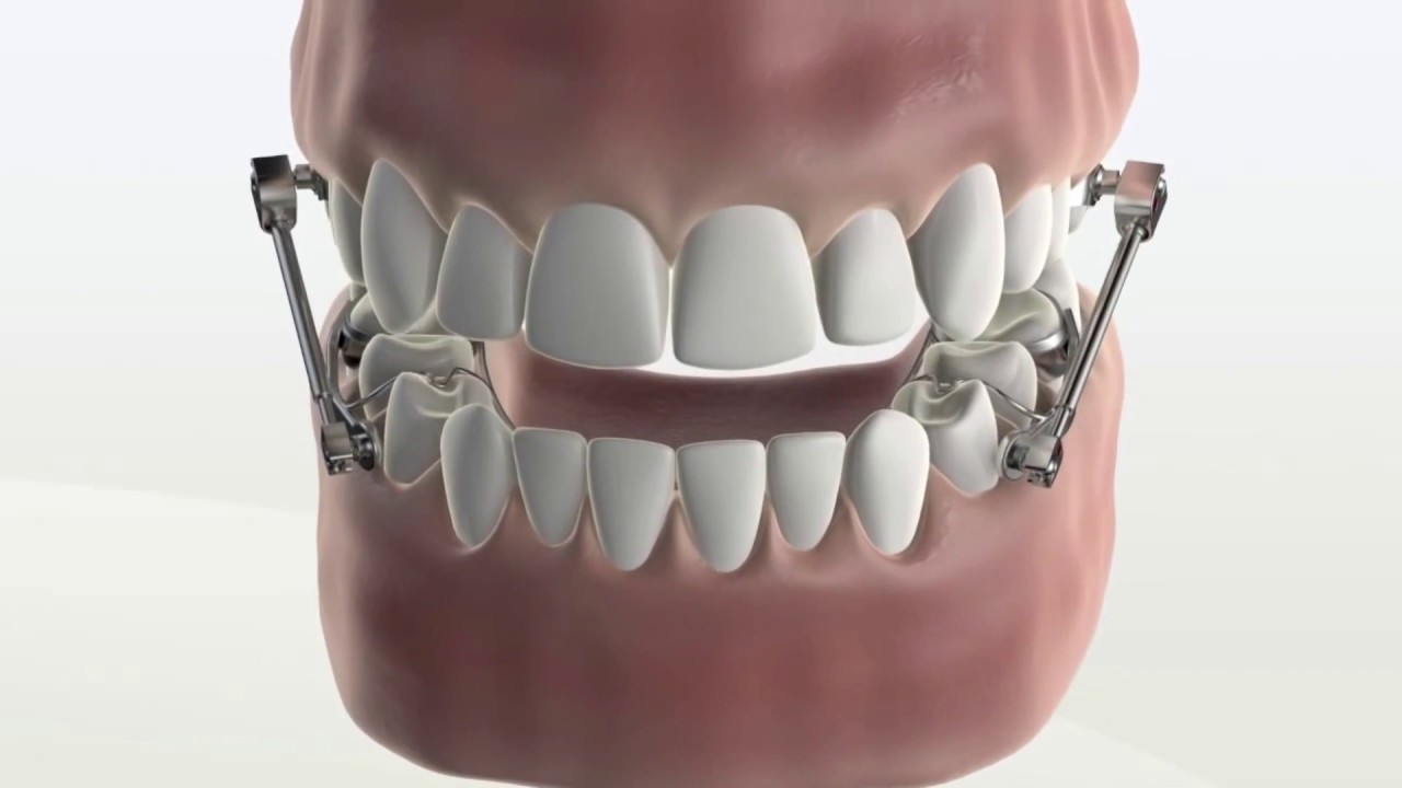 Herbst en ortodoncia para el avance mandibular