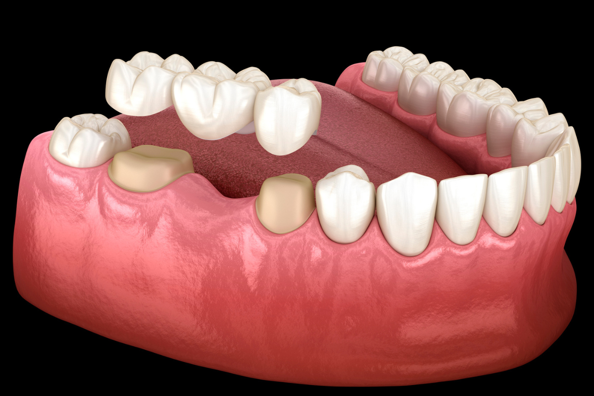 Puente dental sobre dientes naturales: qué es, cuándo está indicado y cuáles son sus ventajas